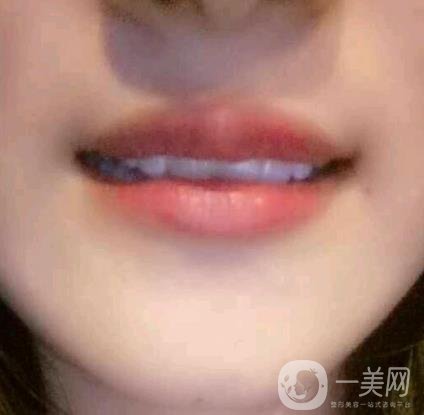 北京市海淀醫(yī)院整牙多少錢？看價(jià)格表及案例*果