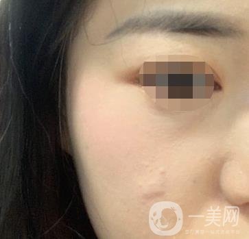 河北省中醫(yī)院整形美容科去疤*果如何？?jī)r(jià)格表及案例實(shí)拍圖公布