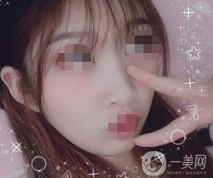 河北省中醫(yī)院整形美容科去疤*果如何？?jī)r(jià)格表及案例實(shí)拍圖公布