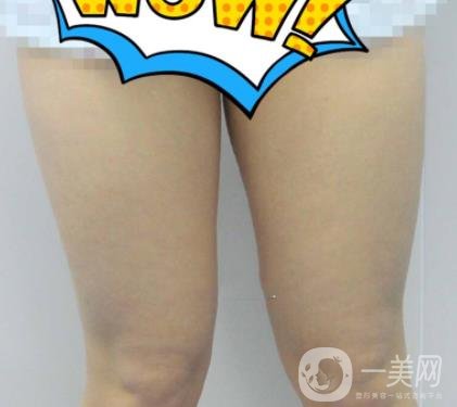 鹽城東方女子整形醫(yī)院價(jià)格表_抽脂瘦身案例