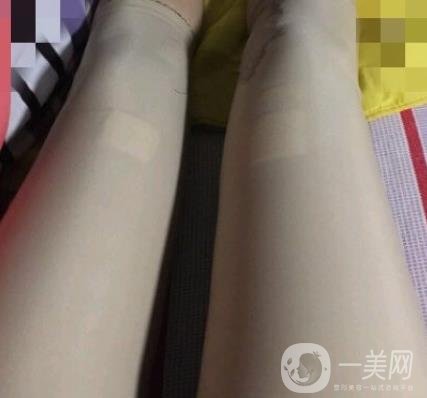 鹽城東方女子整形醫(yī)院價(jià)格表_抽脂瘦身案例