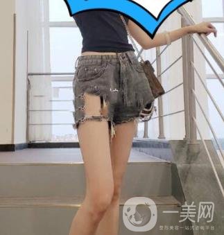 鹽城東方女子整形醫(yī)院價(jià)格表_抽脂瘦身案例