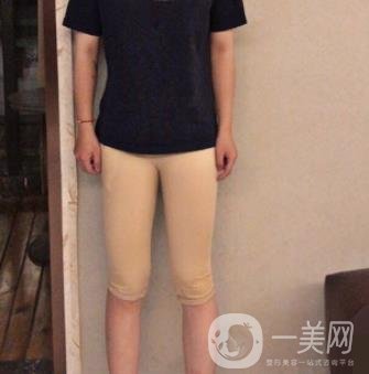 鹽城東方女子整形醫(yī)院價(jià)格表_抽脂瘦身案例