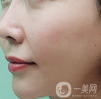 蘭州軍區(qū)陸軍總院皮膚科價(jià)格表_祛痣案例展示