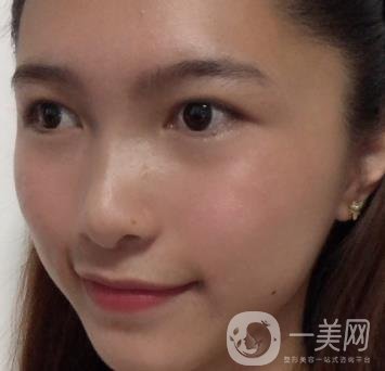 沈陽軍區(qū)總醫(yī)院整形外科價(jià)格表2020，附雙眼皮案例