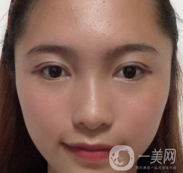 沈陽軍區(qū)總醫(yī)院整形外科價(jià)格表2020，附雙眼皮案例