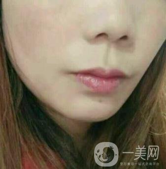 鹽城東方女子整形醫(yī)院價(jià)格表_點(diǎn)痣*果一覽