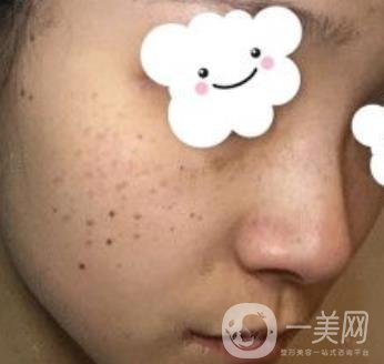 浙二醫(yī)院整形美容科價格表*新版，附激光祛斑*終*果圖