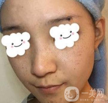 浙二醫(yī)院整形美容科價格表*新版，附激光祛斑*終*果圖