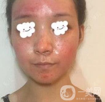 浙二醫(yī)院整形美容科價格表*新版，附激光祛斑*終*果圖