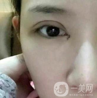 北京克萊美舍張冰潔雙眼皮評價怎么樣？案例及價格表一覽