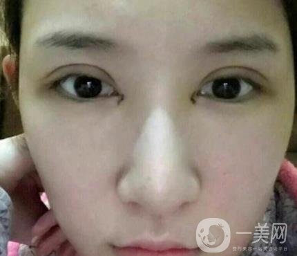 北京克萊美舍張冰潔雙眼皮評價怎么樣？案例及價格表一覽