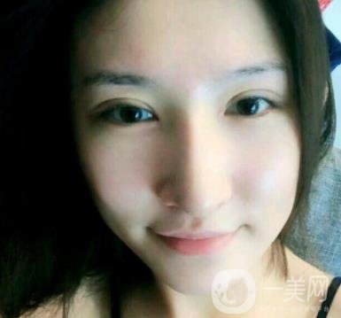 北京克萊美舍張冰潔雙眼皮評價怎么樣？案例及價格表一覽