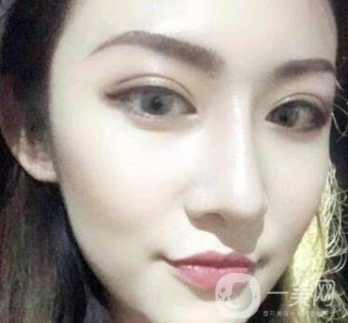 北京克萊美舍張冰潔雙眼皮評價怎么樣？案例及價格表一覽