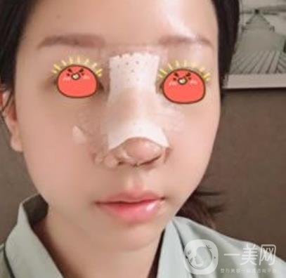 廣東省人民醫(yī)院隆鼻案例及整形價格表分享