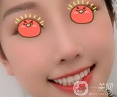 廣東省人民醫(yī)院隆鼻案例及整形價格表分享