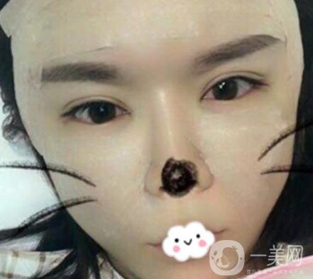 師俊莉脂肪填充面部