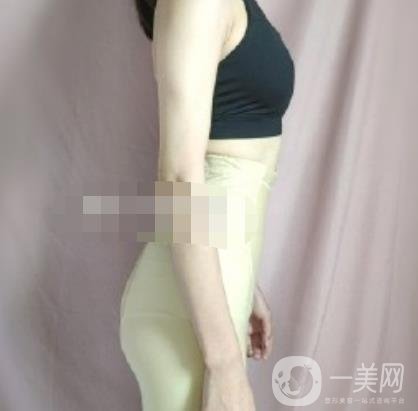 安陽地區(qū)醫(yī)院抽脂