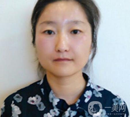 龍崗中心醫(yī)院整形外科價格表（收費）,附去斑案例詳情