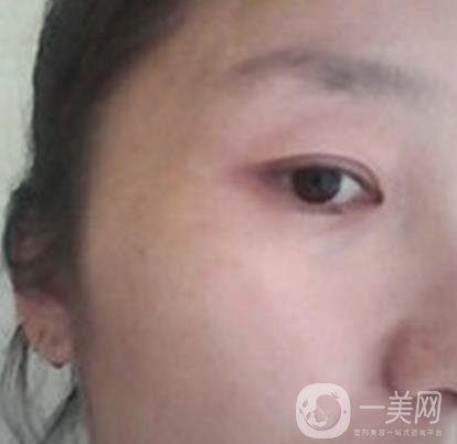 龍崗中心醫(yī)院整形外科價格表（收費）,附去斑案例詳情