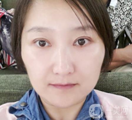 龍崗中心醫(yī)院整形外科價格表（收費）,附去斑案例詳情