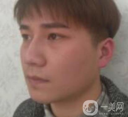 棗莊市立醫(yī)院燒傷整形美容科做光子嫩膚好嗎？價格表及術(shù)后*果分享