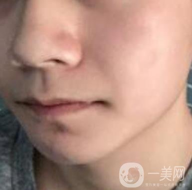 棗莊市立醫(yī)院燒傷整形美容科做光子嫩膚好嗎？價格表及術(shù)后*果分享