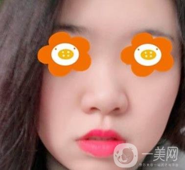 重慶西南醫(yī)院整形外科價(jià)格表2020_自體脂肪填充鼻部案例