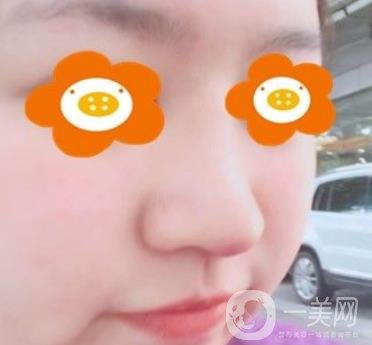 重慶西南醫(yī)院整形外科價(jià)格表2020_自體脂肪填充鼻部案例