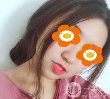 重慶西南醫(yī)院整形外科價(jià)格表2020_自體脂肪填充鼻部案例