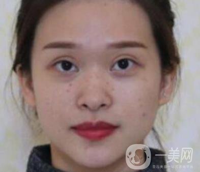 臨沂市人民醫(yī)院價(jià)格表2020_雙眼皮案例分享