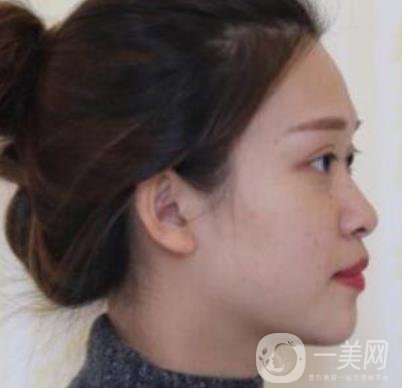 臨沂市人民醫(yī)院價(jià)格表2020_雙眼皮案例分享