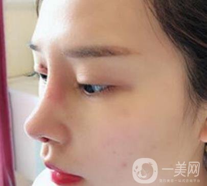 臨沂市人民醫(yī)院價(jià)格表2020_雙眼皮案例分享