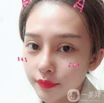 臨沂市人民醫(yī)院價(jià)格表2020_雙眼皮案例分享