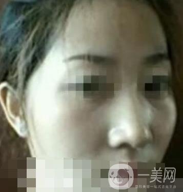 邢臺(tái)市人民醫(yī)院美容科陳譽(yù)華*案例_價(jià)格表明細(xì)