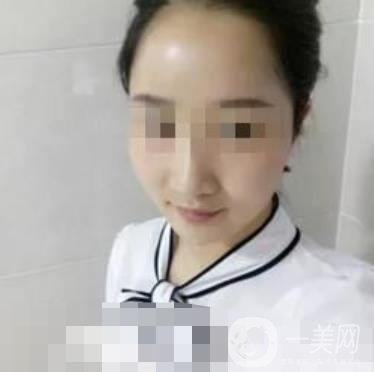 邢臺(tái)市人民醫(yī)院美容科陳譽(yù)華*案例_價(jià)格表明細(xì)