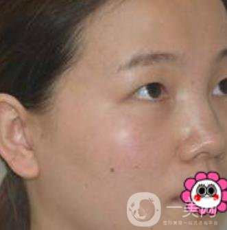 河南省人民醫(yī)院誰做雙眼皮好？附案例及2020整形價(jià)格表