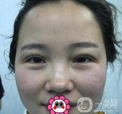 河南省人民醫(yī)院誰做雙眼皮好？附案例及2020整形價(jià)格表