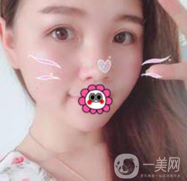 河南省人民醫(yī)院誰做雙眼皮好？附案例及2020整形價(jià)格表