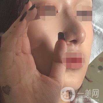 遼寧省人民醫(yī)院美容科怎么樣？附袁繼龍隆鼻案例