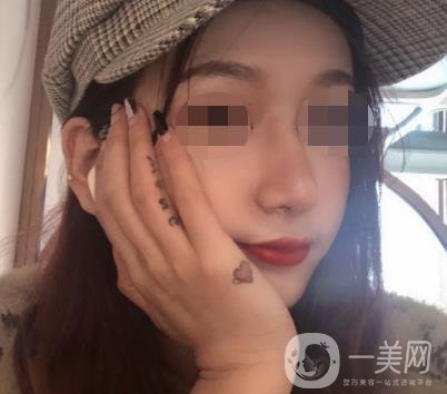 遼寧省人民醫(yī)院美容科怎么樣？附袁繼龍隆鼻案例