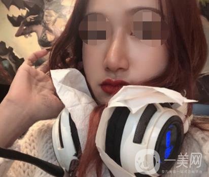 遼寧省人民醫(yī)院美容科怎么樣？附袁繼龍隆鼻案例