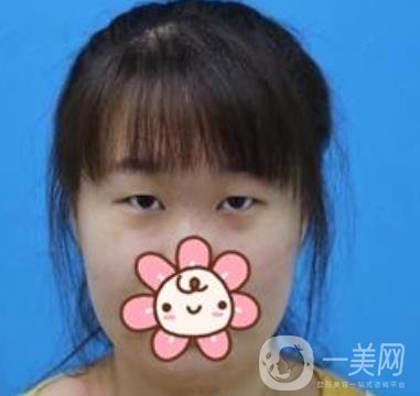 2020浙江省人民醫(yī)院整形價格表，附雙眼皮案例