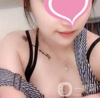 福州市第一醫(yī)院隆胸