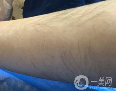 廈門中醫(yī)院陳華脫毛靠譜嗎？?jī)r(jià)格表及案例*果一覽