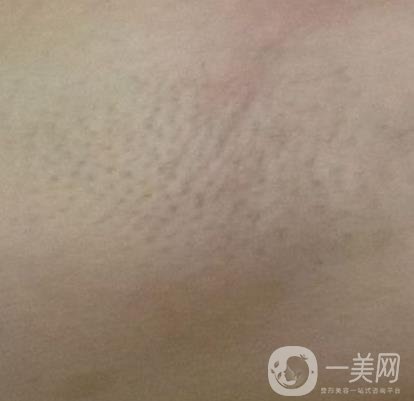 廈門中醫(yī)院陳華脫毛靠譜嗎？?jī)r(jià)格表及案例*果一覽