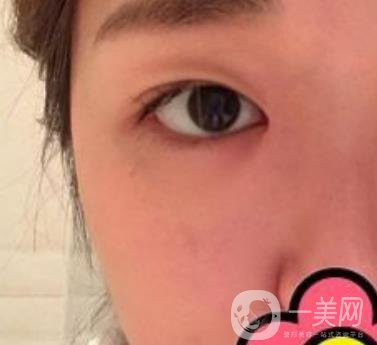 山大二院整形科2020價(jià)格表公布,附雙眼皮案例術(shù)后*果圖