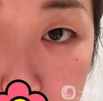 山大二院整形科2020價(jià)格表公布,附雙眼皮案例術(shù)后*果圖