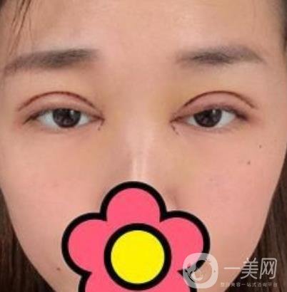 山大二院整形科2020價(jià)格表公布,附雙眼皮案例術(shù)后*果圖