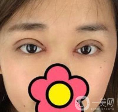 山大二院整形科2020價(jià)格表公布,附雙眼皮案例術(shù)后*果圖